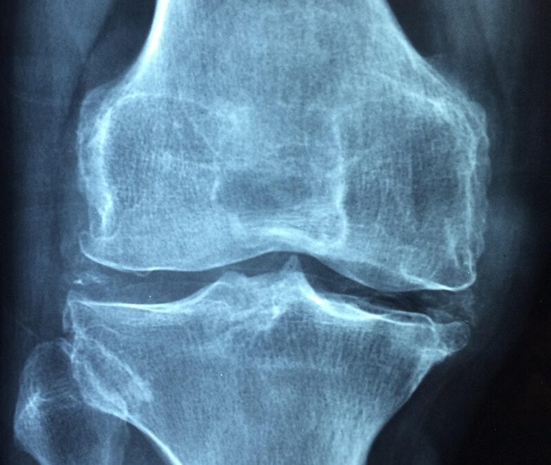 Osteoporose – aktiv bleiben, Knochen stärken